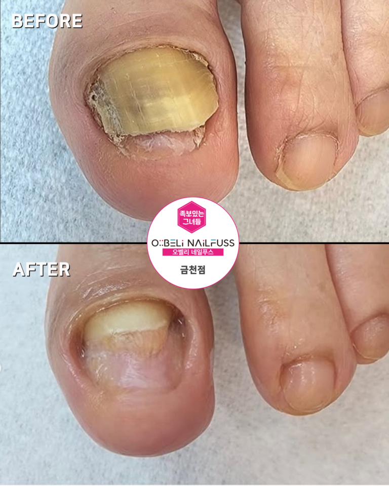 두꺼운 문제성발톱 관리