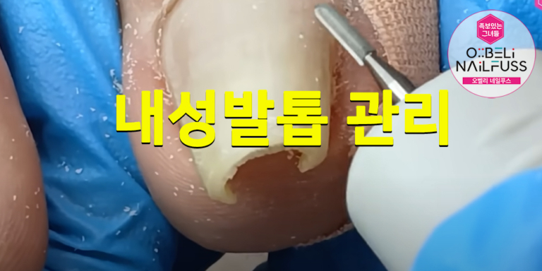 내성발톱 관리