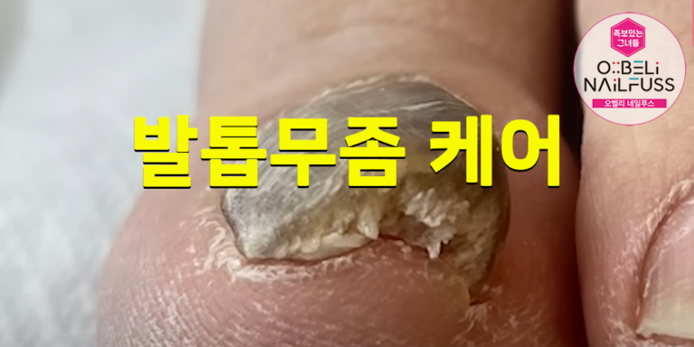 발톱무좀 케어