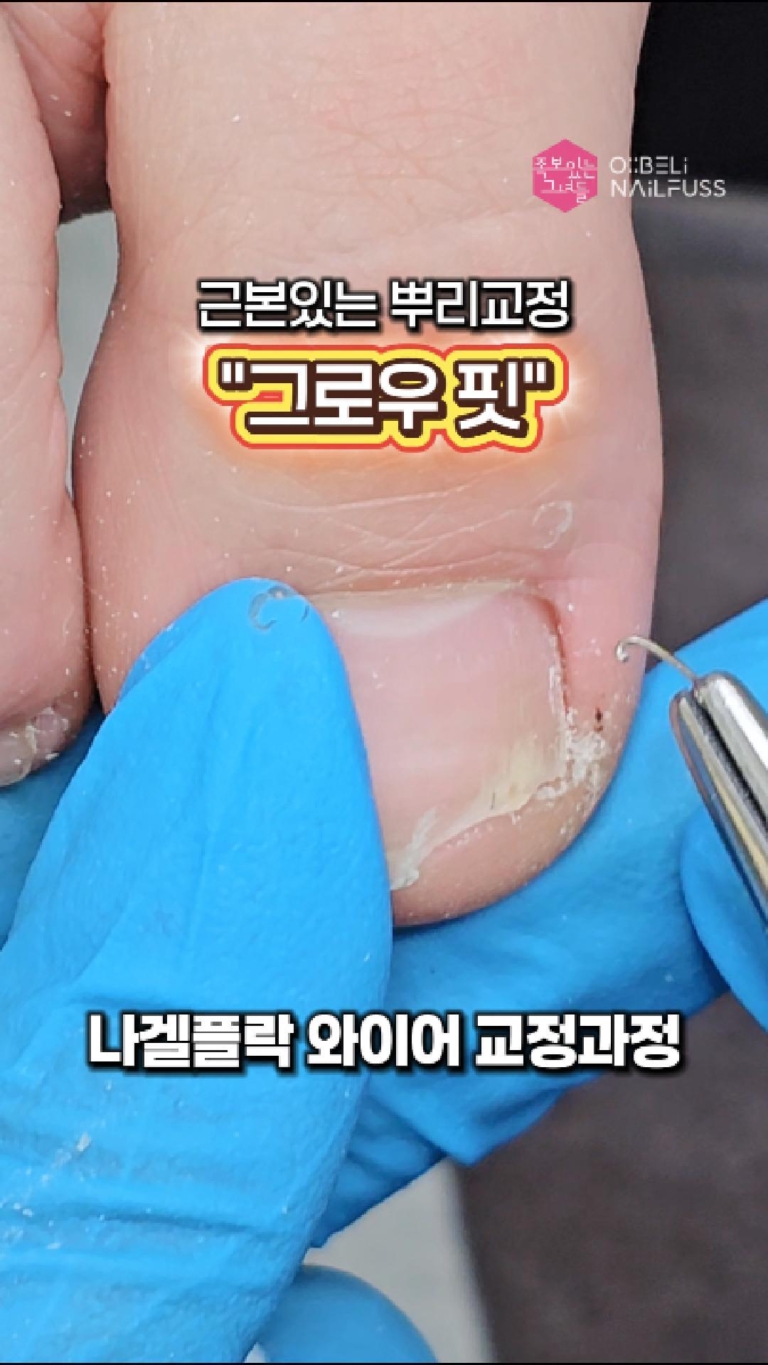 063_교정기_나겔플락_01_Cover
